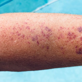 Mire utalnak a bőrvérzések, bevérzések? című cikk nyitóképe