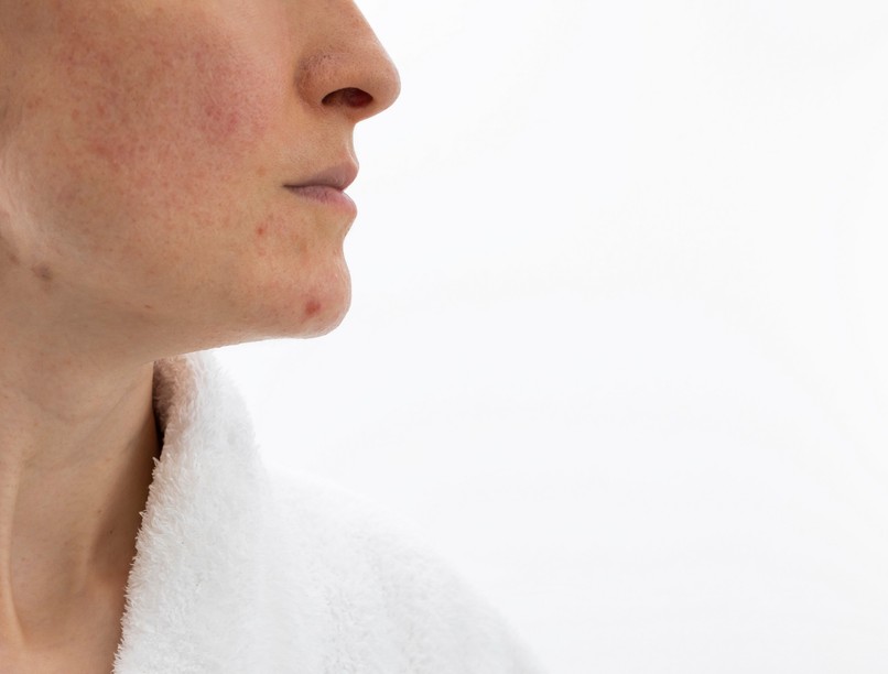 Pókhálóer orr arc rosacea ellen