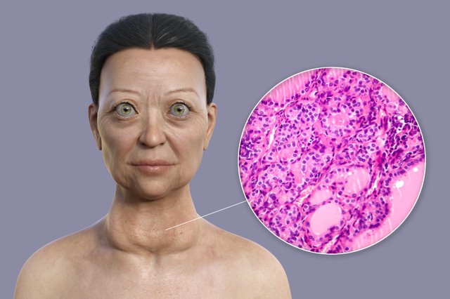 Basedow-kór: tünetei, vizsgálata és kezelési lehetőségei