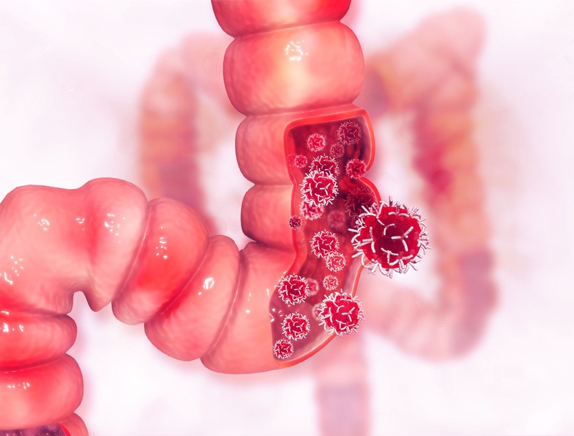 vastagbélrák, végbélrák, oka, tünete, esélye, étel