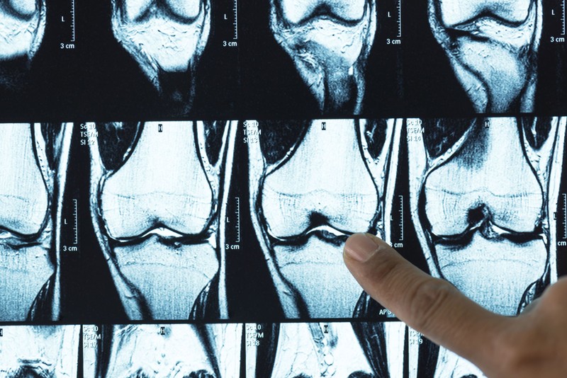 Felfedezték, miért pusztul el a porcszövet az osteoarthritisben, és hogyan lehet azt helyreállítani