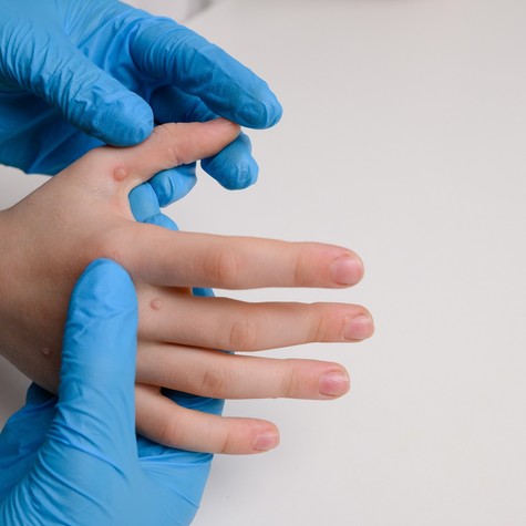 Szemölcseltávolítás lézerrel – fontos tudnivalók, mielőtt belevágna című cikk nyitóképe