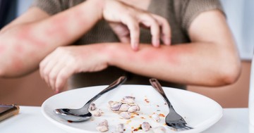 Ételallergia: ilyen, amikor allergiás kiütések jelzik