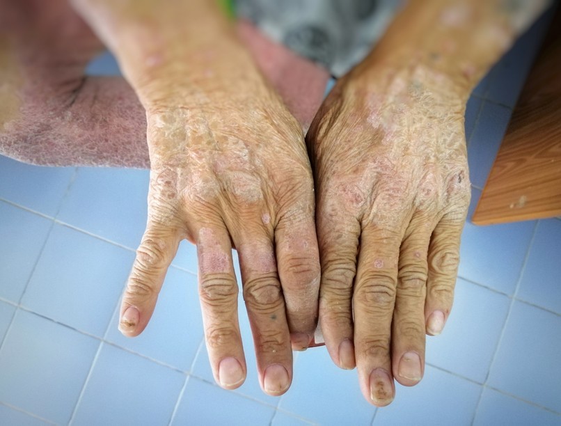 Kemény érdes bőr oka scleroderma bőrbetegség