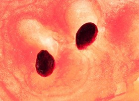 Görögdinnyével - a korai hipertónia ellen?