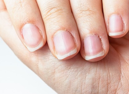 Berepedezik a körömágya? Így ápolja a bőrét, hogy megelőzze a fájdalmat  című cikk nyitóképe