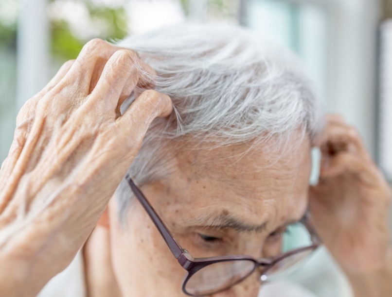 bőrbetegségek, fejbőr, zsíros, lerakódás, seborrhoeás dermatitis