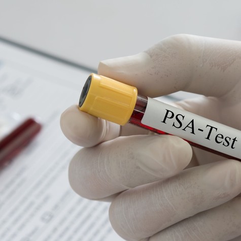 PSA-vizsgálatra készül? A vizsgálat előtti napok eseményei is befolyásolhatják az eredményt című cikk nyitóképe
