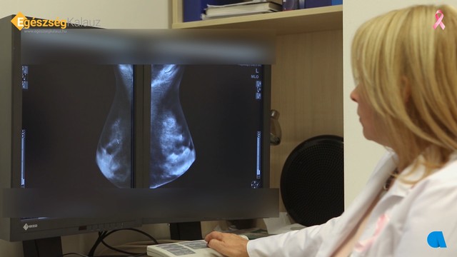 Így segíti a mesterséges intelligencia (AI) az emlőrák kiszűrését