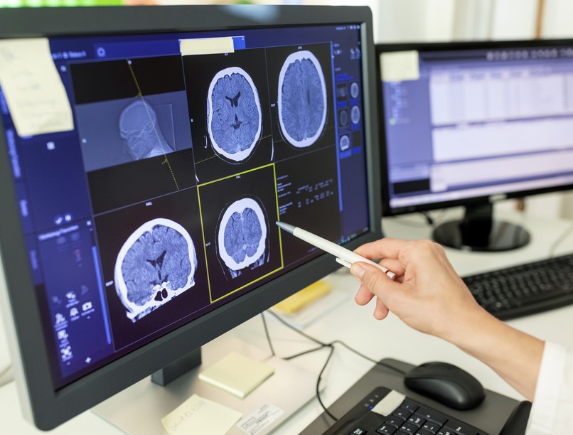 agydaganat, agyrák, diagnosztizálás, biopszia, vérkép