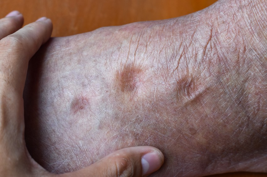 Az ödéma kialakulása, az ödémás láb jelzi a létfontosságú szervek elégtelen működését, de allergiás reakciók, illetve fertőző betegségek következtében is kialakulhat. Ödéma akkor jön létre, ha felbomlik a szövetközti folyadék termelésének és elvezetésének egyensúlya, emiatt pedig a szövetek közötti térben visszamarad a folyadék és vizenyő keletkezik.