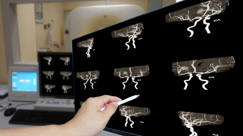 sztrok hogyan ismerhető fel vérzéses stroke