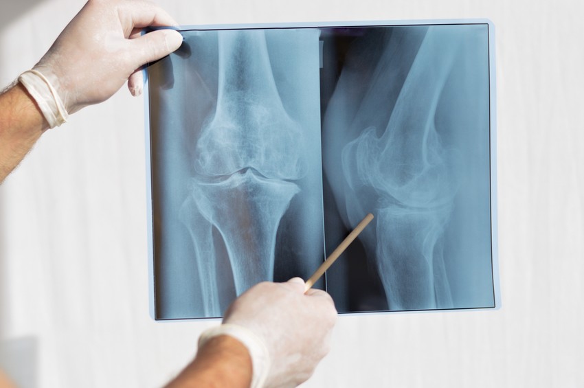 Az ortopéd vagy reumatológus szakorvos először fizikális vizsgálatot végez, majd röntgen vagy MR-vizsgálatot kérhet.