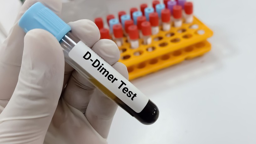 Mit jelent D-dimer érték laborlelet