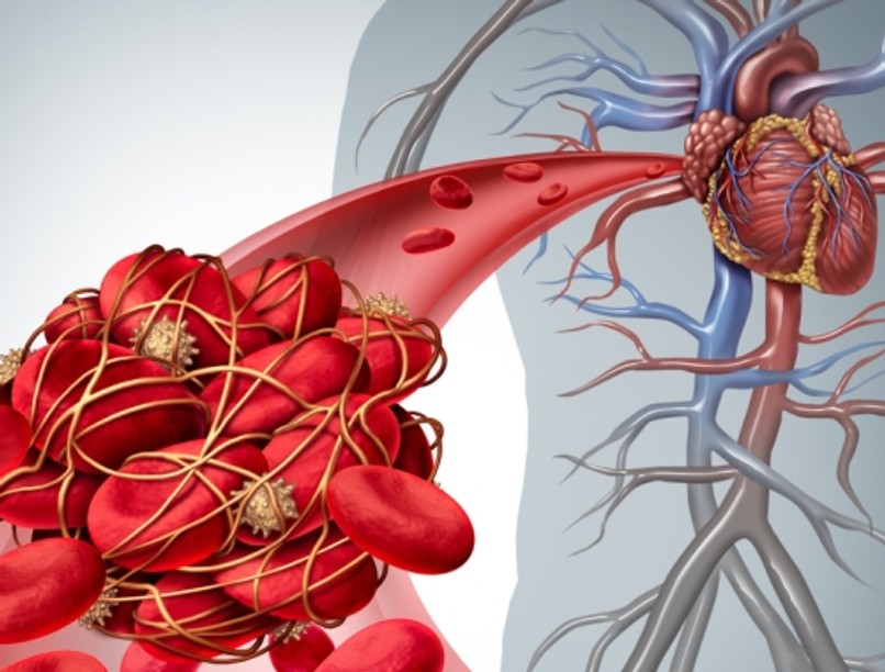 Előfordulhat, hogy véralvadásgátló terápia mellett is kialakulnak új vérrögök.