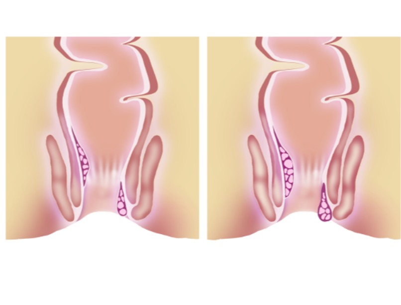 Az aranyér fokozatai