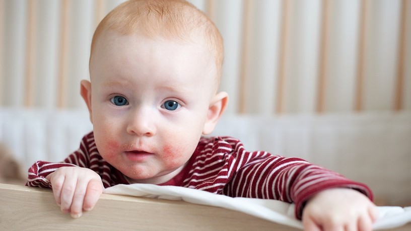 atópiás dermatitisz, ekcéma, atópiás ekcéma, bőrbetegség