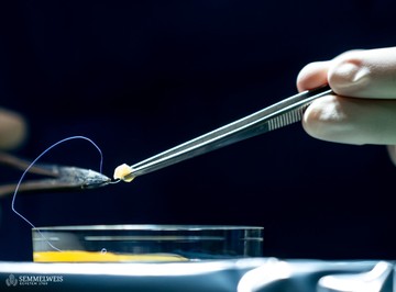 A petefészek kéregállomány részleteket a már nem működő petefészek felszínére erősítették.