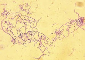 Anthrax (lépfene): tünetei, vizsgálata és a kezelési lehetőségei