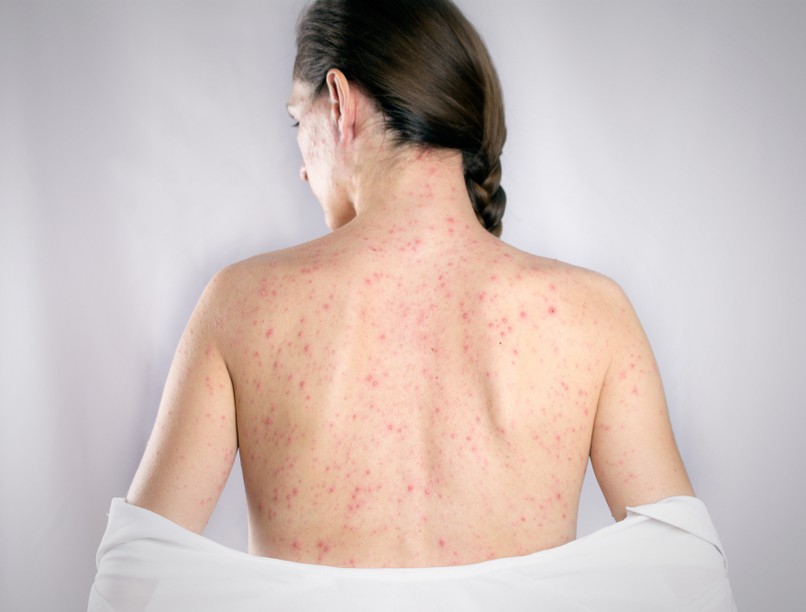 rubella, rózsahimlő, kiütés, tünetek