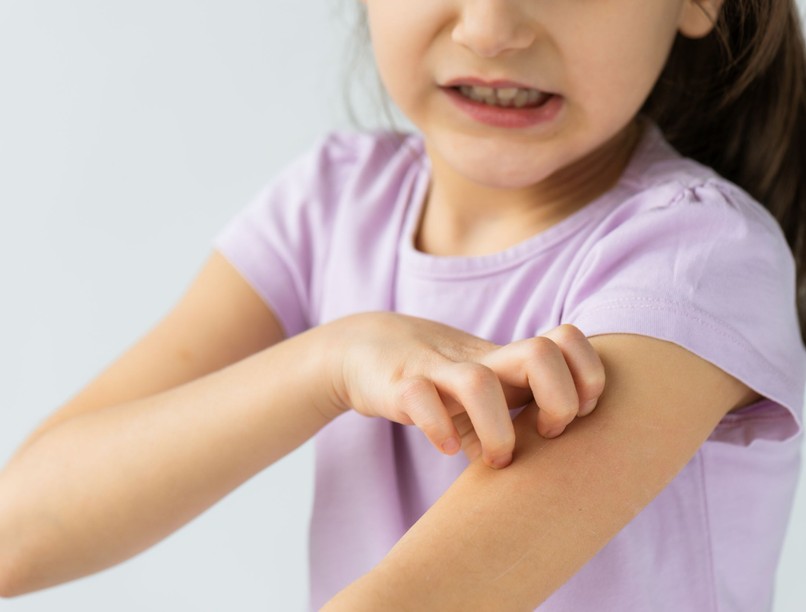 atópiás dermatitisz bőrgyulladás viszketés