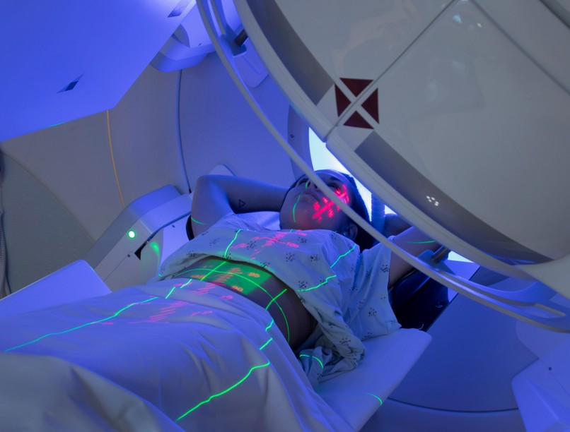 daganatellenes sugárterápia sugárkezelés  besugárzás mellékhatás