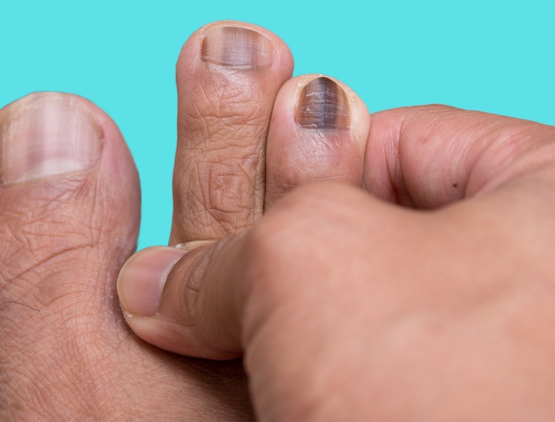 csík elváltozás oka körmök