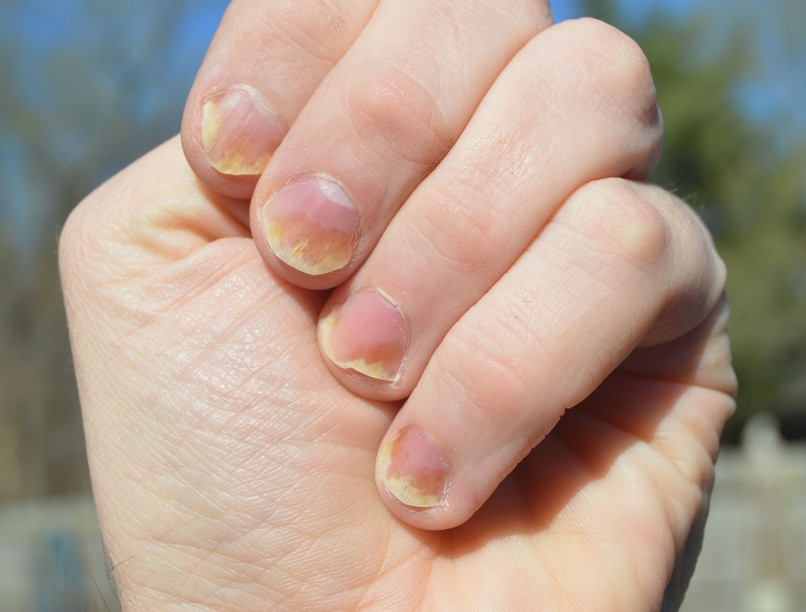 köröm bemélyedés sárga bőrbetegség pikkelysömör