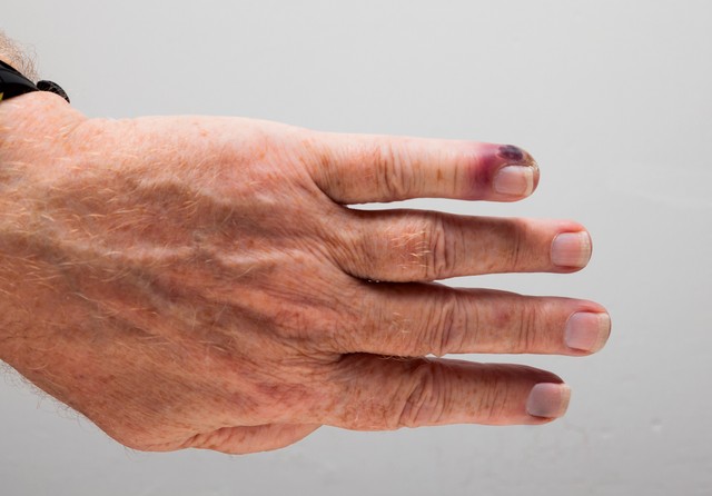 Ha ilyen piros csík indul el  a sebből a szív felé, azonnal keressen orvost!