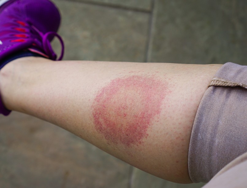 lyme-kór, kullancs, fertőzés, vírus, tünetei, kezelése