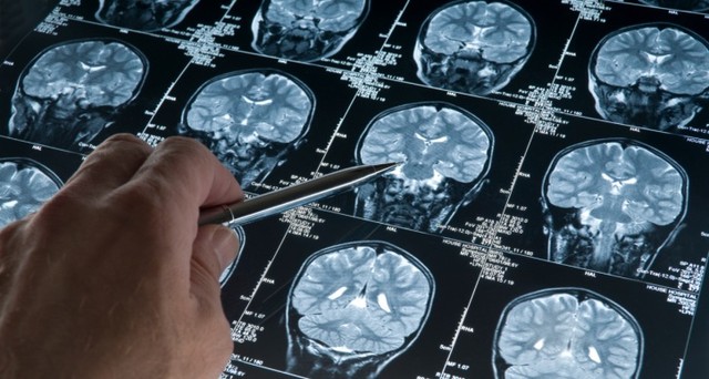 Stroke: milyen szövődményekkel kell szembenéznünk?