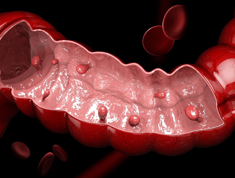 vastagbélrák végbélrák ellen rost