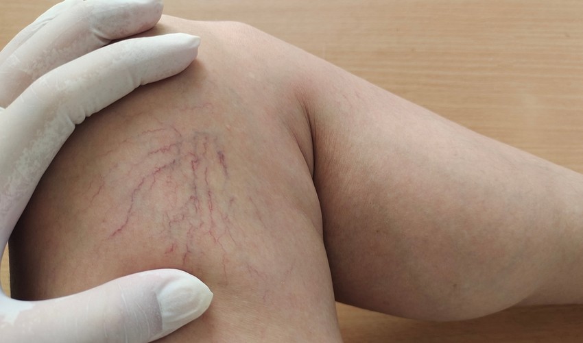 Az érsebész pontosan elmondja, mit kell tenni, ha észleljük a gyulladás tüneteit.