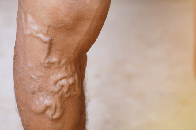 Vérrögképződés: így derülhet ki egy vérvizsgálatból a trombózishajlam