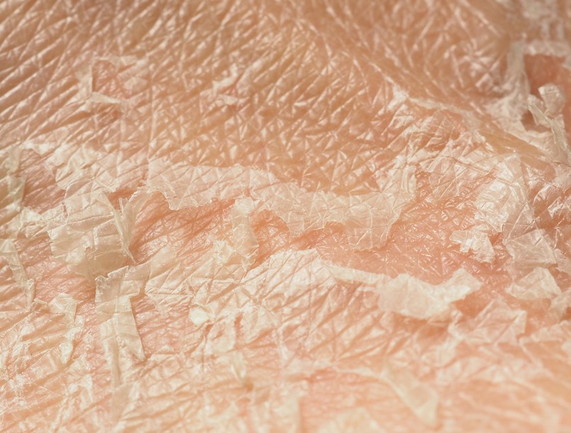 Bőrsérülés bőrgyulladás, bőrirritáció, seb tünet vizsgálat kezelés