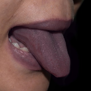 Mire utal a szederjesség (kékes bőrszín)? című cikk nyitóképe