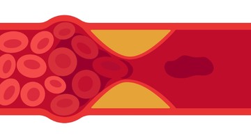 Agyvérzés, stroke esetén ezek a hétköznapi tünetek még időben jelzik, ha baj van