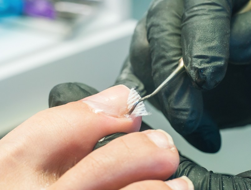 Benőtt köröm nemcsak szűk cipő okozhatja