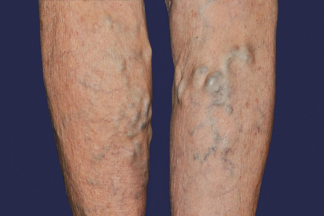 Kidudorodó, kanyargós visszerek:  a vénás trombózis csendben okozhat bajt