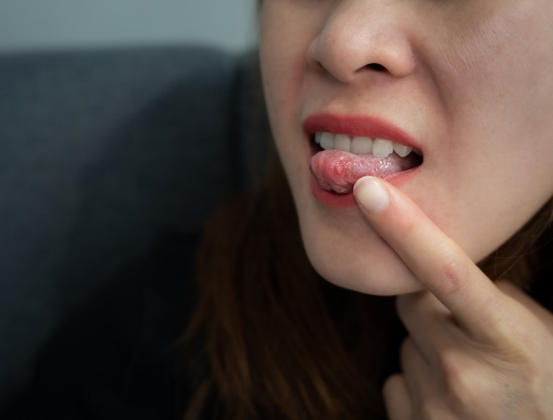 nyelvrák csomó folt nyelv tünet