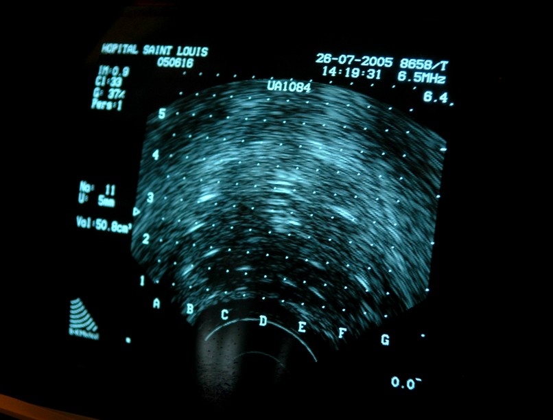 sugárterápia brachyterápia kezelés leírás