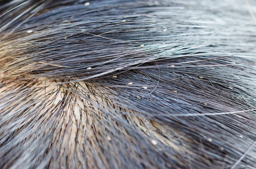 A fejtetvek a korpával ellentétben - nem húzhatók le könnyen a hajszálról, kézzel nem lehet lesöpörni, csak úgy távolíthatók el, ha fésűvel lehúzzák a hajszál végéről.