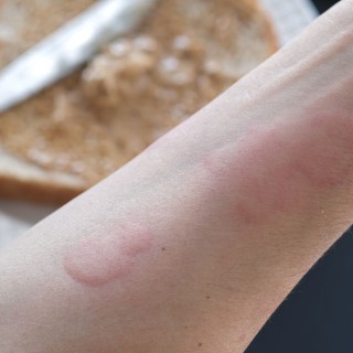 6 betegség és állapot, ami csalánkiütést okoz című cikk nyitóképe