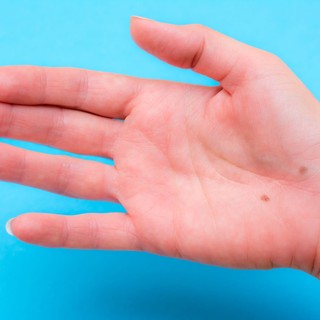 Mit jelent az anyajegy a tenyéren vagy a kézen? Kevesen tudják, hogy a jellemünk is kiolvasható belőle című cikk nyitóképe