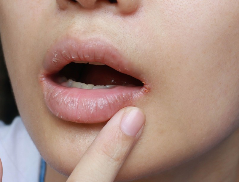 berepedt fájdalmas szájszeglet oka, candida