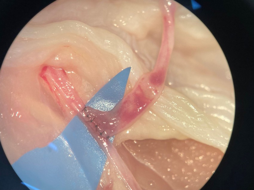 A bypass-műtét során általában a beteg saját, megkímélt vénáit (leggyakrabban a lábszárból vett saphena véna) vagy artériáit (mellkasból vett belső emlőartéria, vagy néha a kar radiális artériája) használják fel, hogy az elzáródott érszakaszokat megkerülve biztosítsanak véráramlást az oxigénhiányos szívizomnak (koszorúér-bypass) vagy az elzáródott végtagi artériának. Ezek az érszakaszok "graftok" néven funkcionálnak, átirányítva a vért az akadályon.