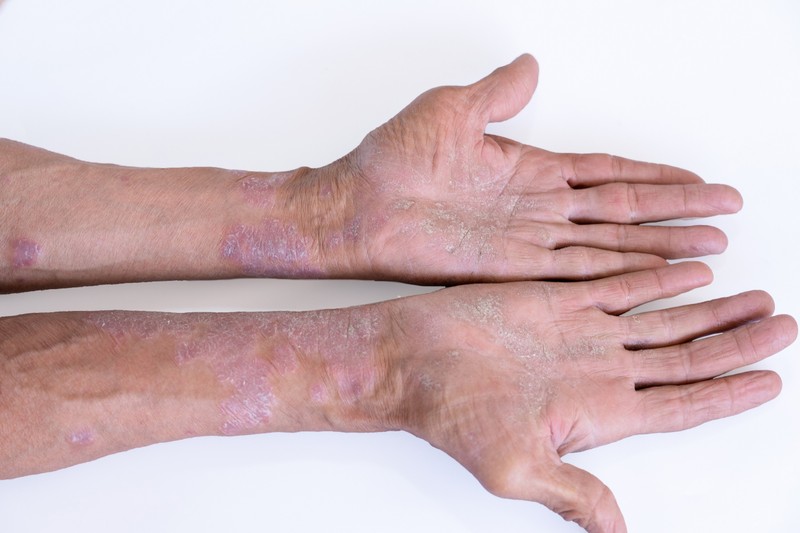 Mintegy 200 ezer magyar él pikkelysömörrel, de nem csak őket érinti a betegség