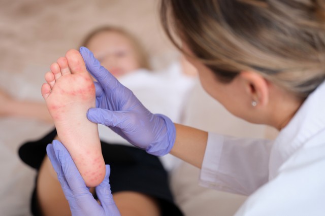 Körömgomba, lábgomba gyermekeknél: így lehet megelőzni a legkönnyebben