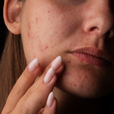 Felnőttkori pattanások: miért nem csak kamaszprobléma? című cikk nyitóképe