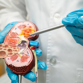 Wilms-tumor: tünete, vizsgálata és kezelési lehetőségei című cikk nyitóképe